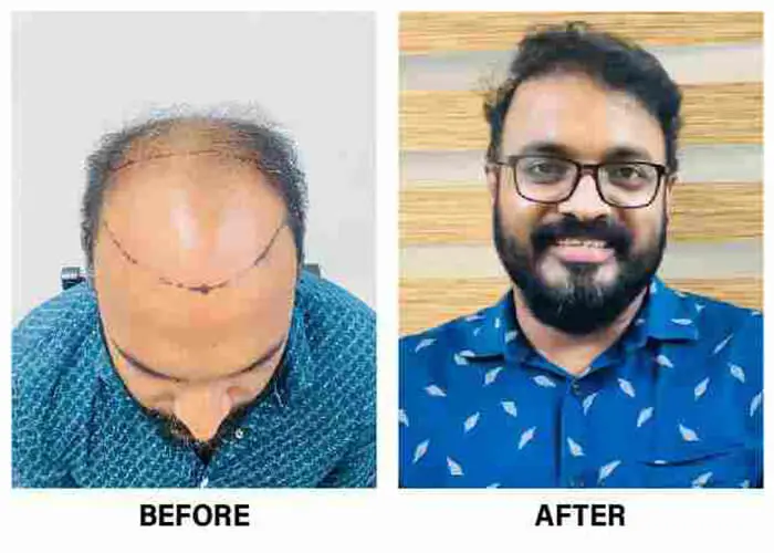 Best_hair_transplant_treatment